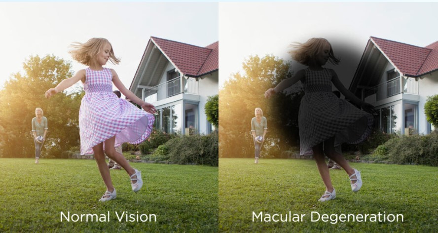 Macular Degeneration